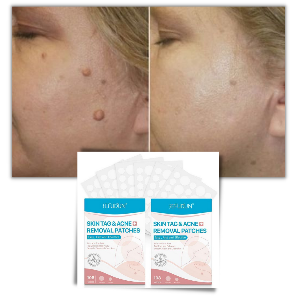 Skin tag removal treatment patch