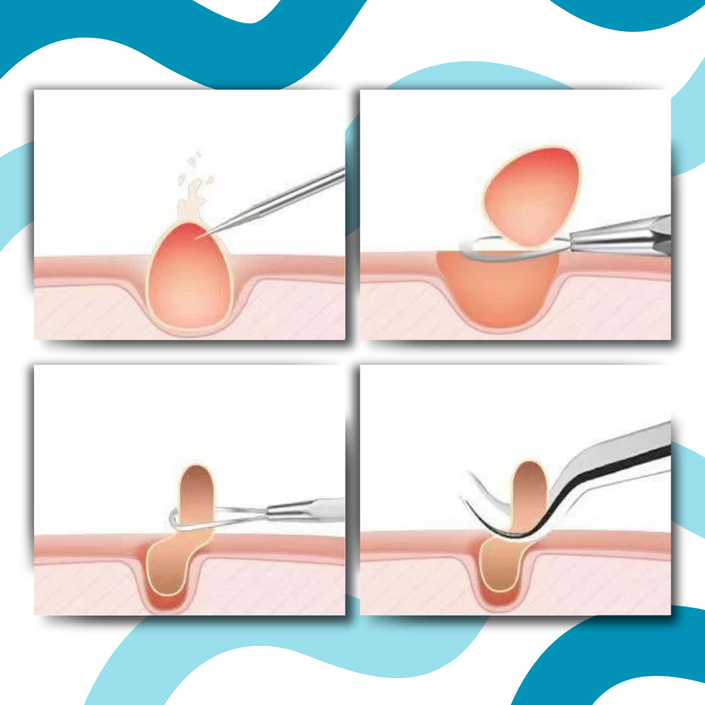 Ultra Precision Pointed Tweezers - Ozerty