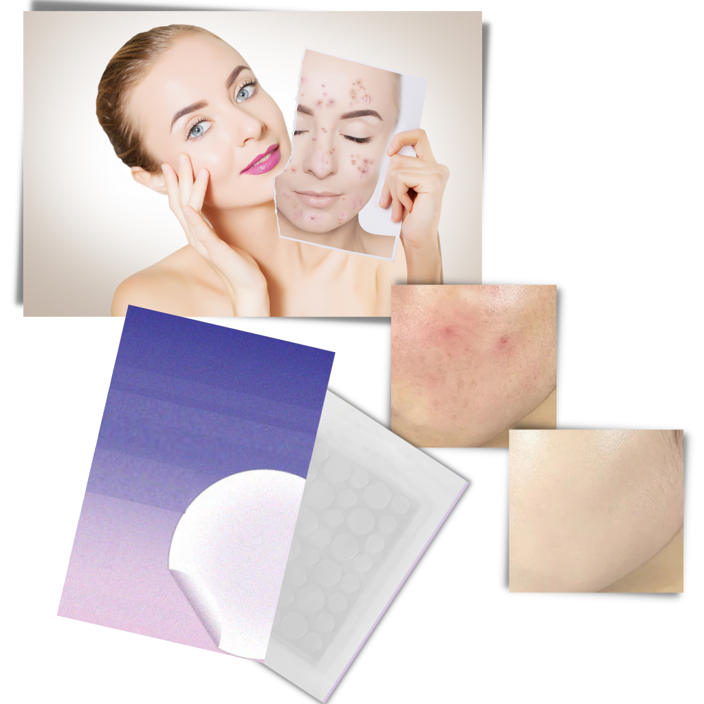 36-Pack Invisible Acne Patches