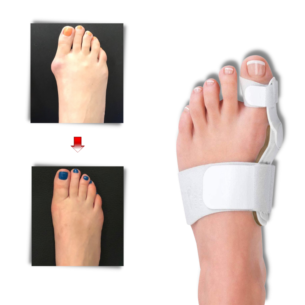 Orthopaedic Bunion Corrector