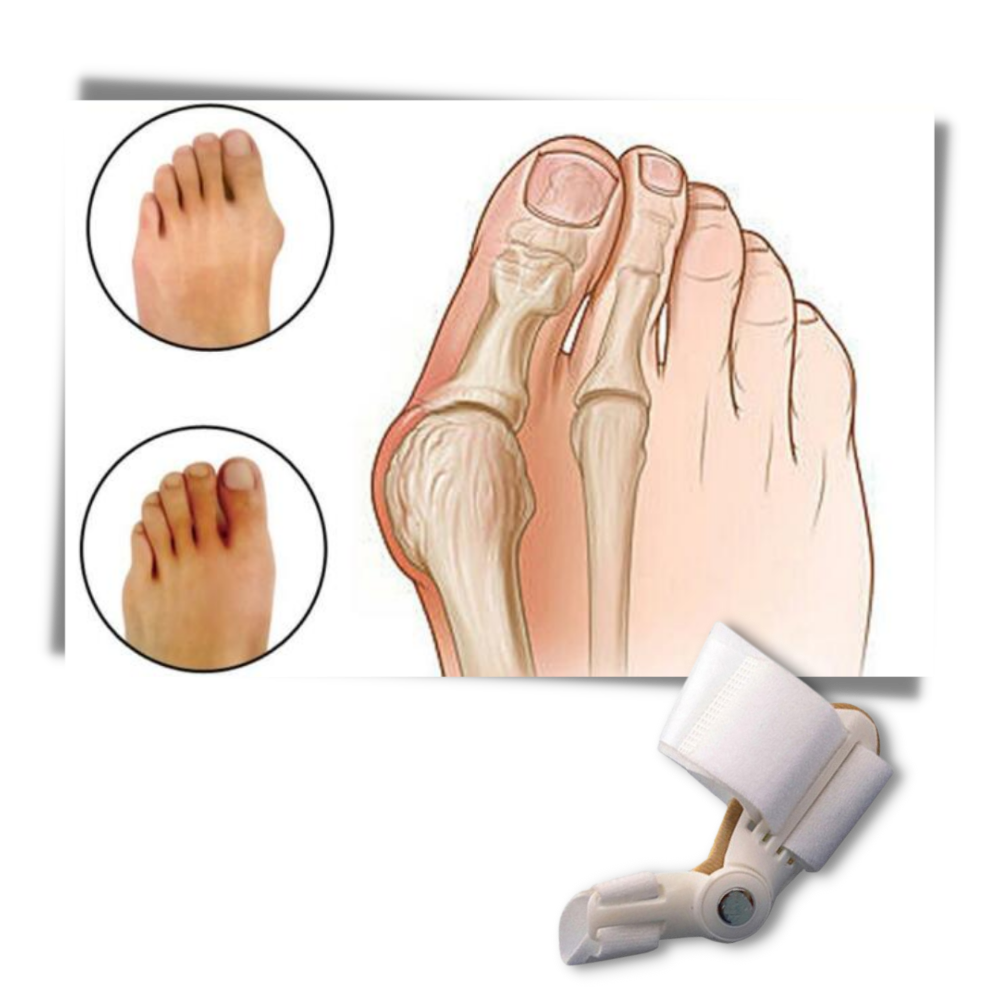 Orthopaedic Bunion Corrector