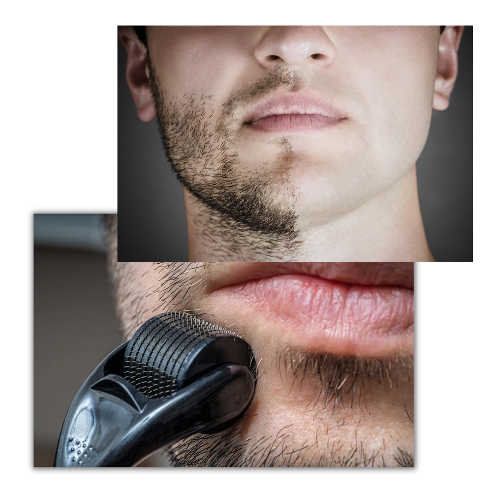 Derma roller for hair and beard growth