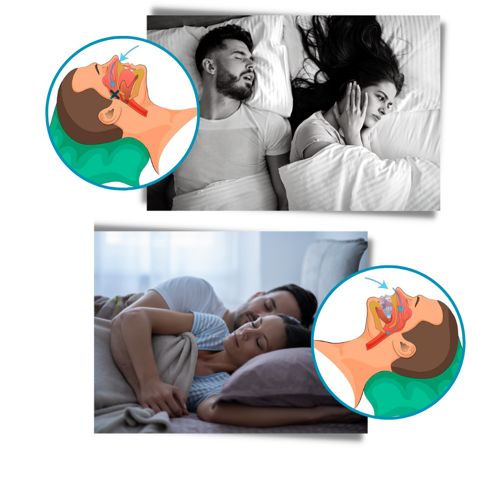 Advanced Anti-Snoring Device - Ozerty